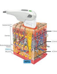 HIFU face lifting treatment Singapore