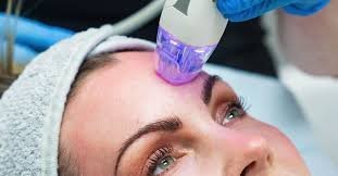 Radiofrequency microneedling skin treatment Singapore